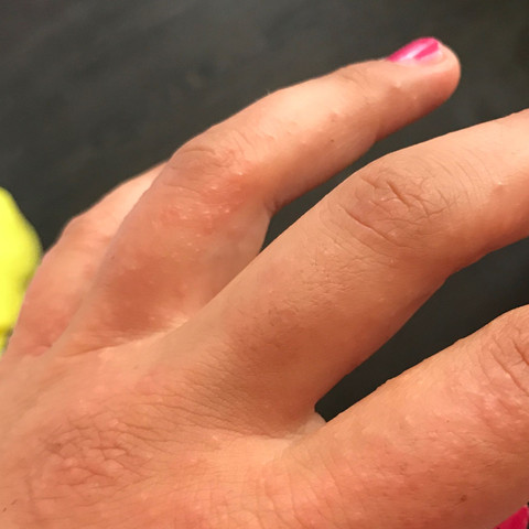 Linke Hand am 5. Tag  - (Allergie, Ausschlag)