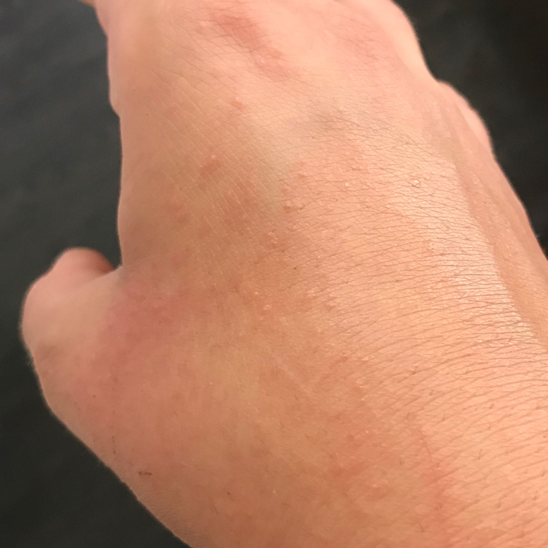 Juckende picklige Hand ( jetzt auch am Fuß ) was könnte das sein? (Allergie, Ausschlag) Juckende picklige Hand ( jetzt auch am Fuß ) was könnte das sein? (Allergie, Ausschlag)