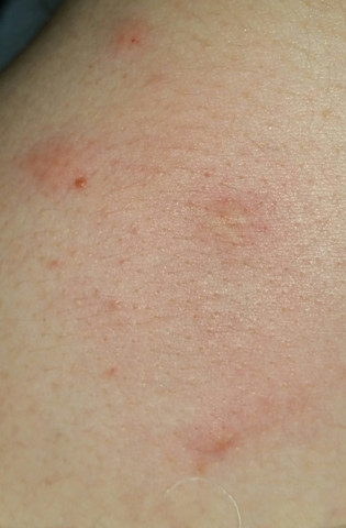 Juckende Quaddeln Was Ist Das Gesundheit Haut Juckreiz Juckende Quaddeln Was Ist Das Gesundheit Haut Juckreiz