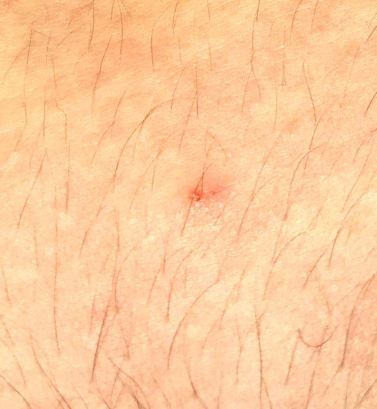 Juckende rote Punkte auf der Haut. Woher kommen die? (Gesundheit und ...