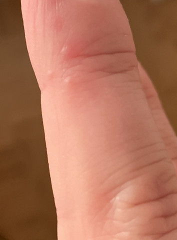 Wieder finger am immer herpes ᐅ Fingerherpes