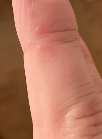 Juckende Schmerzende Blaschen Auf Dem Mittelfinger Blaeschen Juckende Schmerzende Blaschen Auf Dem Mittelfinger Blaeschen