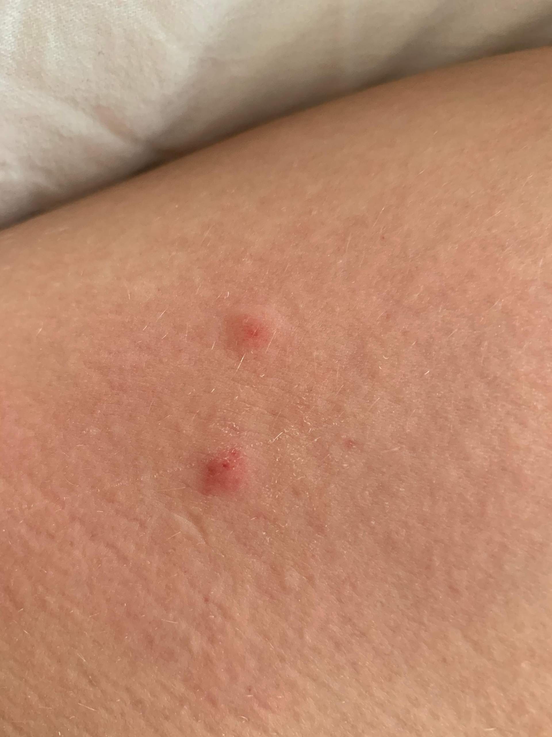 Wann Hört Das Jucken Nach Läusebehandlung Auf Juckende Stellen am Oberschenkel? (Gesundheit und Medizin)