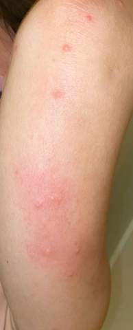 Juckende Stichartige Pusteln Am Ganzen Korper Verteilt Gesundheit Und Medizin Haut Juckende Stichartige Pusteln Am Ganzen Korper Verteilt Gesundheit Und Medizin Haut