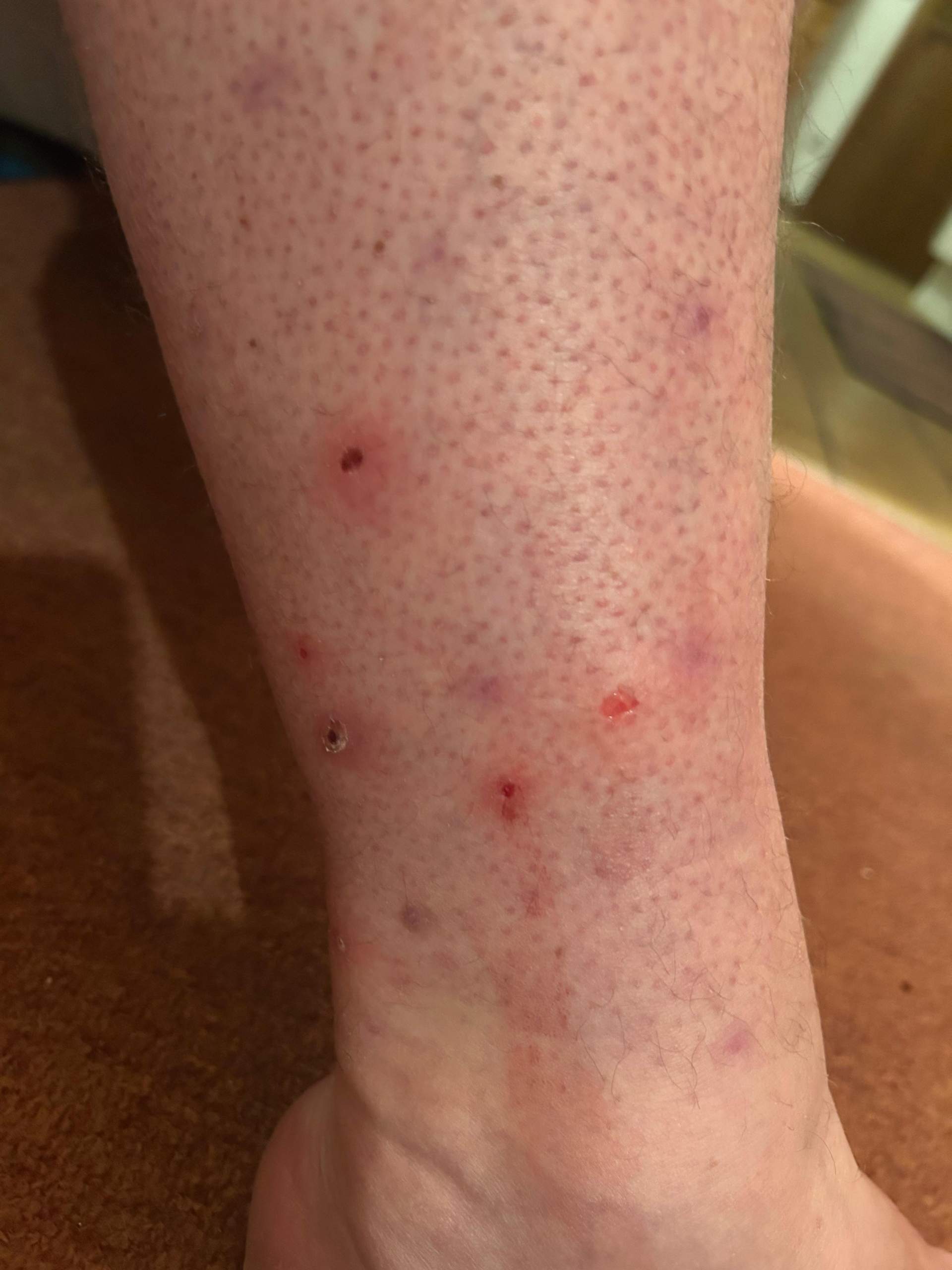 Juckende Stiche an Beinen und Füßen? (Dermatologie, Hauterkrankung)