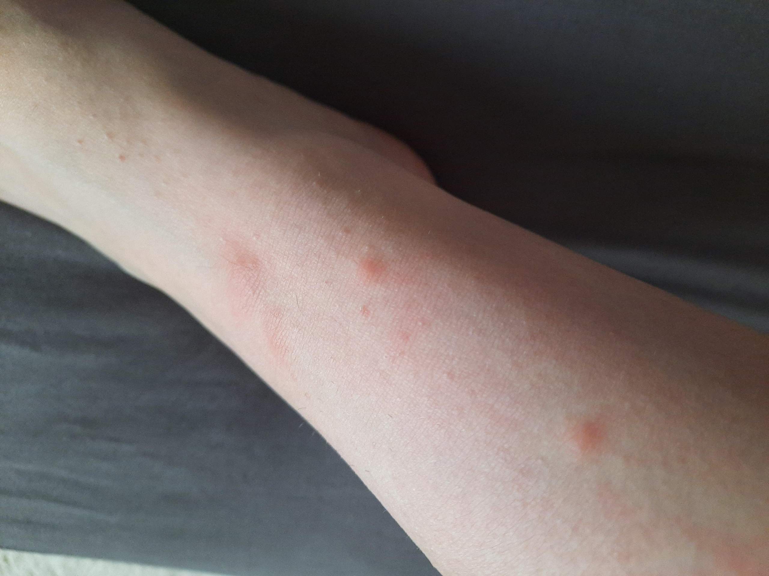 Plötzlich Stiche Auf Der Haut