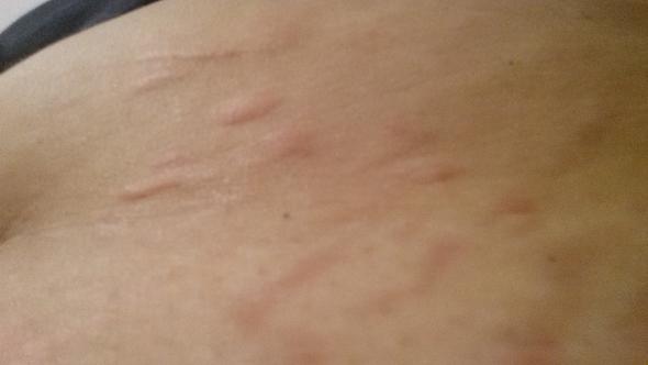 Juckende Stiche Im Winter Stechmucke Krankheit Mucken Juckende Stiche Im Winter Stechmucke Krankheit Mucken