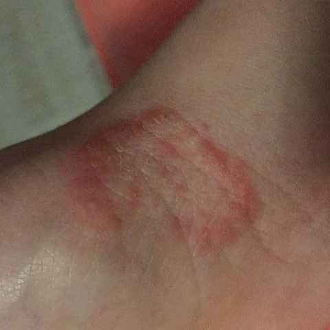 Mein brennendes und juckendes Handgelenk - (Haut, Allergie, Ausschlag)