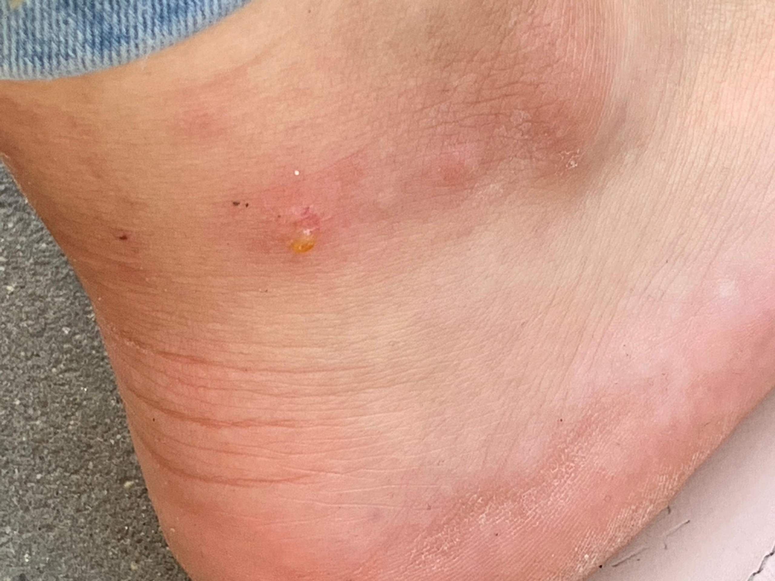 Juckende Wasserblase am Fuß? (Gesundheit und Medizin, Gesundheit, Haut)