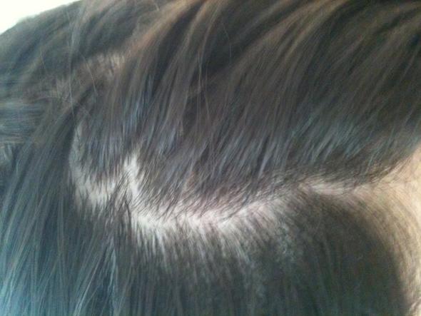 juckende weisse kopfhaut