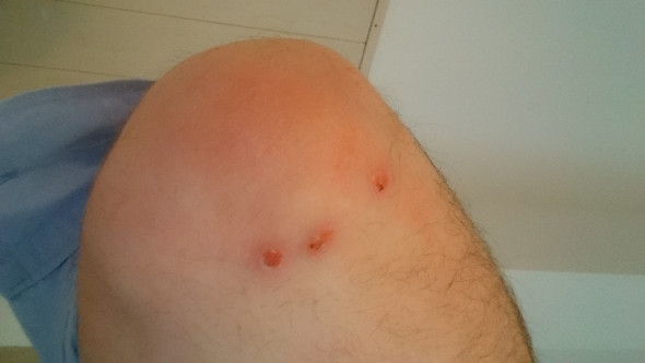 Vor einer Woche - (Wunde, Hautkrankheit, Ellenbogen entzündet)