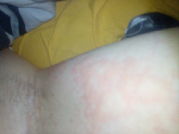 Juckender Ausschlag Am Ganzen Koerper Was Kann Das Sein Gesundheit Und Medizin Arzt Juckreiz Juckender Ausschlag Am Ganzen Koerper Was Kann Das Sein Gesundheit Und Medizin Arzt Juckreiz