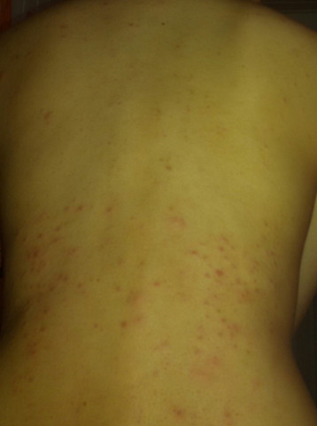 Juckender Ausschlag Am Rucken Durch Kaltwachsen Was Hilft Dagegen Gesundheit Pickel Juckender Ausschlag Am Rucken Durch Kaltwachsen Was Hilft Dagegen Gesundheit Pickel