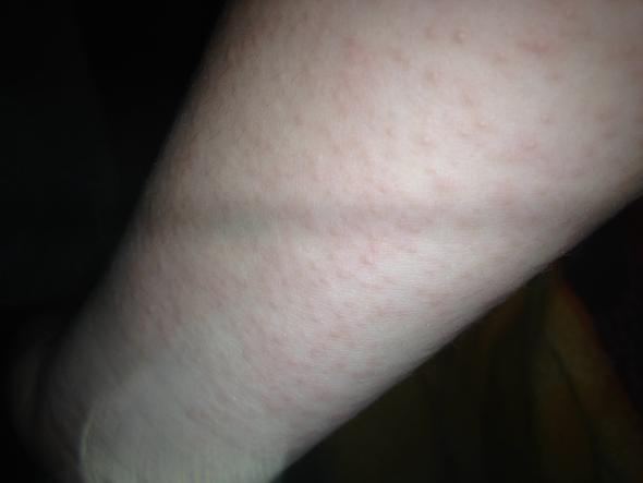 Arm - (Haut, Allergie)