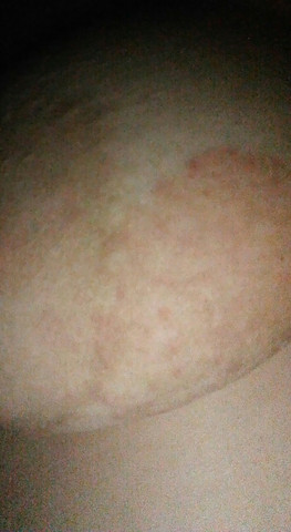 Juckender Ausschlag An Der Linken Brust Gesundheit Krankheit Juckender Ausschlag An Der Linken Brust Gesundheit Krankheit