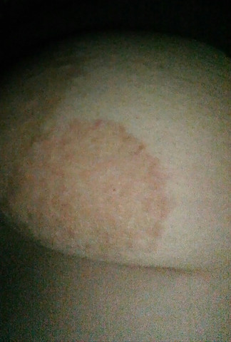 Juckender Ausschlag An Der Linken Brust Gesundheit Krankheit Juckender Ausschlag An Der Linken Brust Gesundheit Krankheit