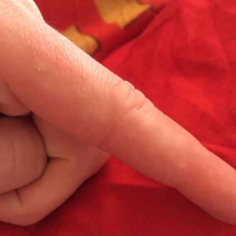 An meinem Finger Wirds immer schlimmer  - (Ausschlag, jucken)