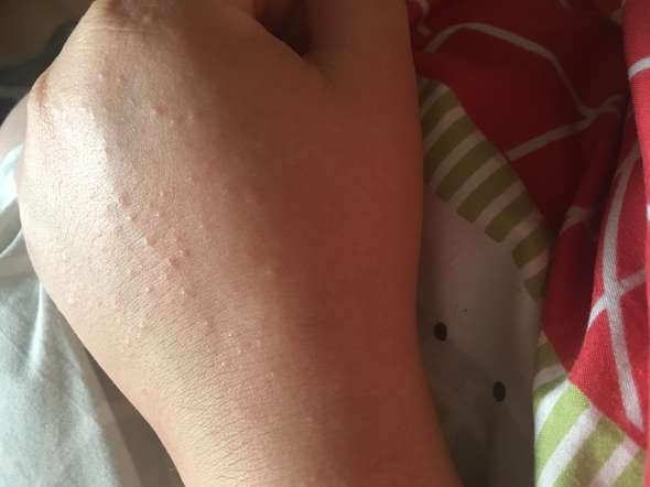 Juckender Ausschlag Auf Beiden Handrucken Gesundheit Und Medizin Juckreiz Dermatologie Juckender Ausschlag Auf Beiden Handrucken Gesundheit Und Medizin Juckreiz Dermatologie