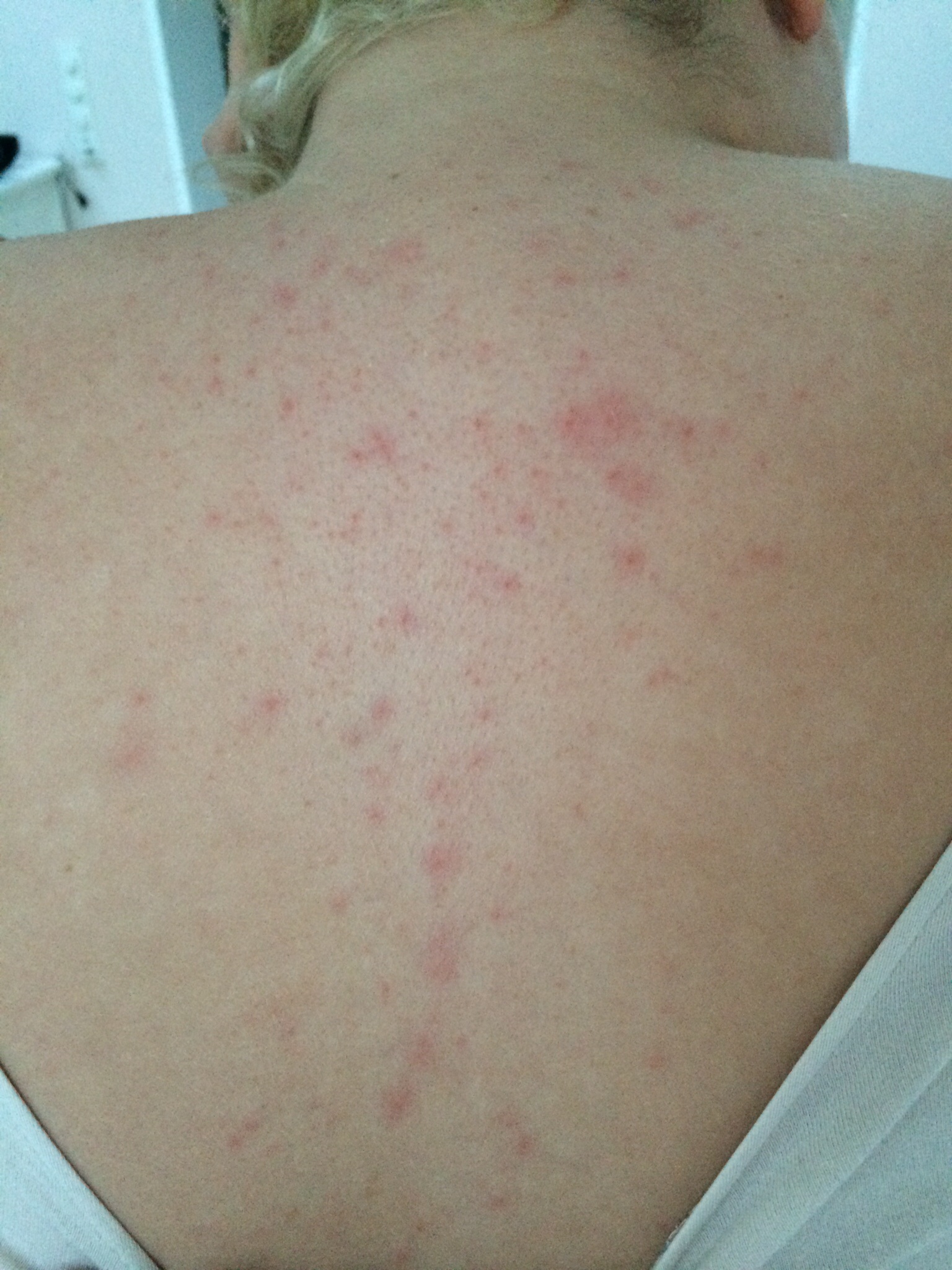 Pickelmale Rücken - was hilft gegen pickelmale am po 95 : Pickelmale am rücken lassen sich pickel auf dem rücken frau