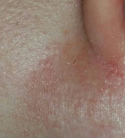 Juckender Hautausschlag Im Gesicht Gesundheit Haut Ausschlag