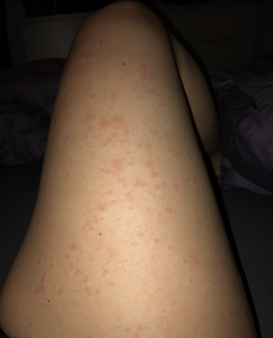 Juckender Hautausschlag Mit Quaddeln Gesundheit Und Medizin Juckreiz Juckender Hautausschlag Mit Quaddeln Gesundheit Und Medizin Juckreiz