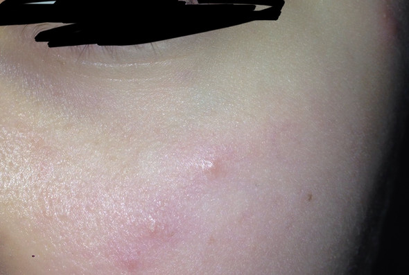 Juckender pickel hilfee!!!? (Haut) pickel jucken