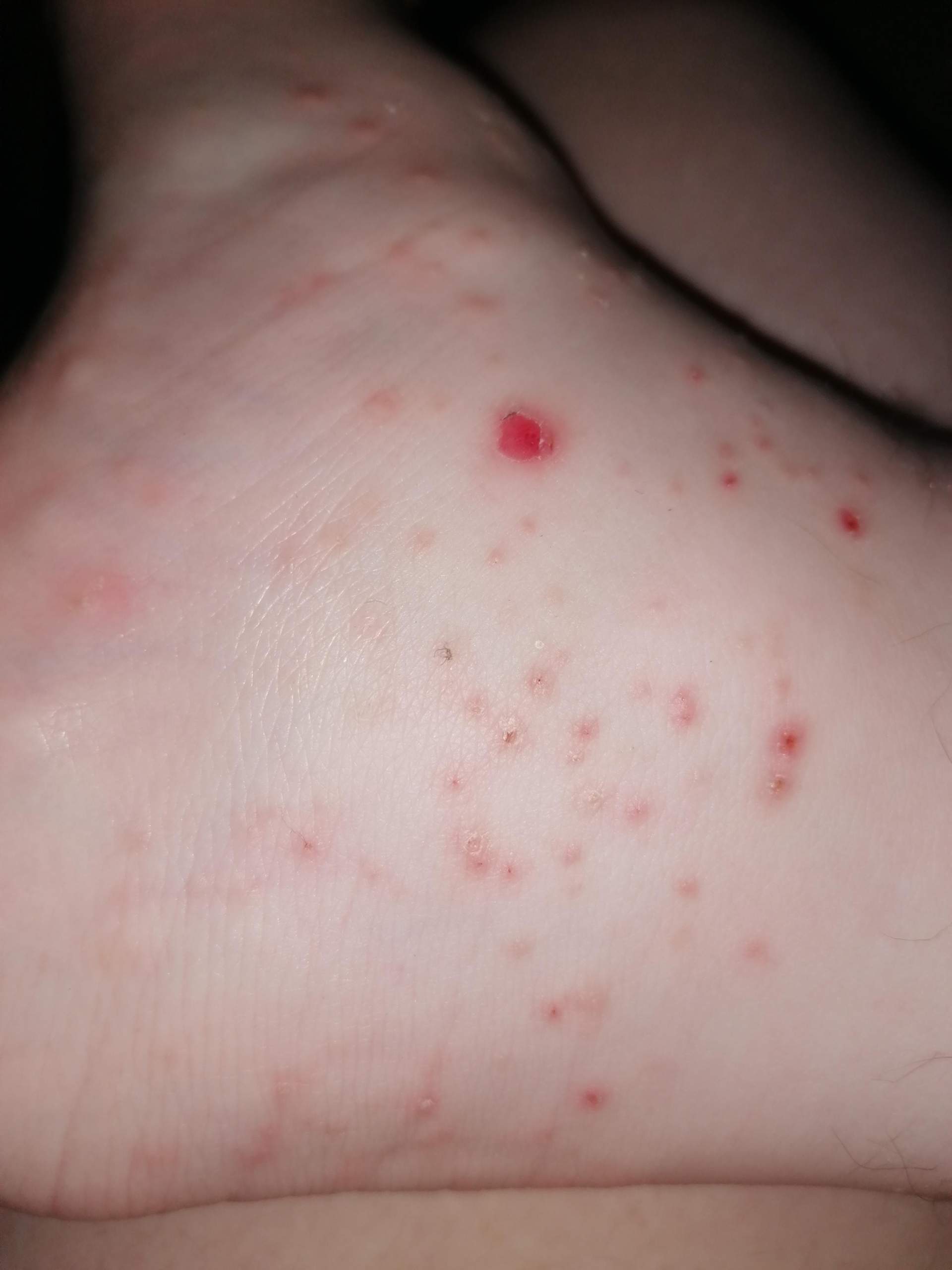 Juckreiz am Fuß Ausschlag? (Gesundheit, Haut, Füße)