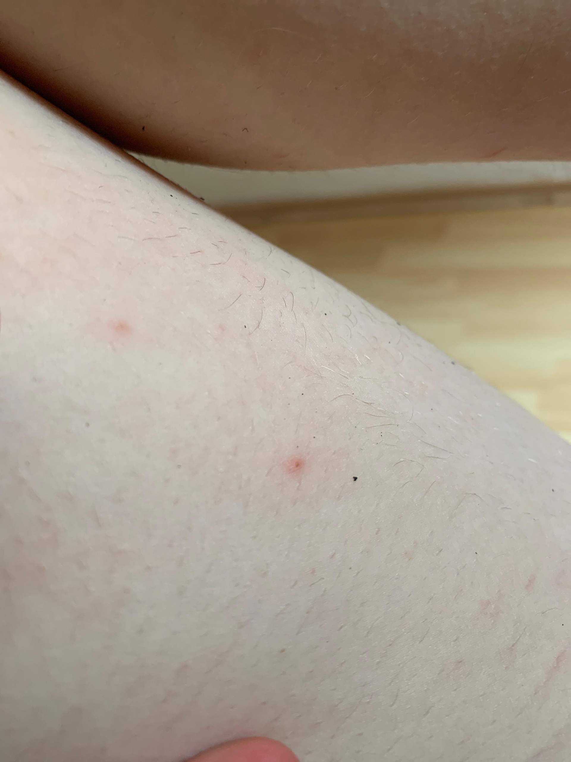 Juckreiz am ganzen Körper (Ausschlag pickelbildung? (Gesundheit und ...