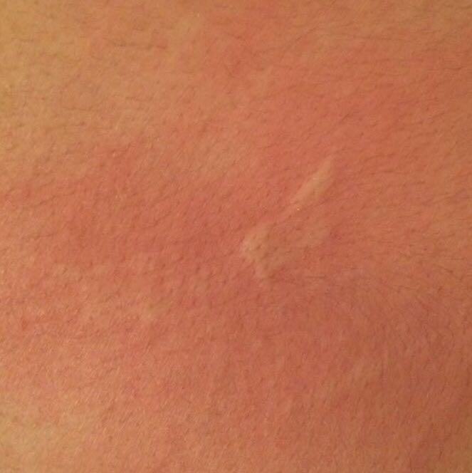 Juckreiz Nach Sonnenbrand Geht Nicht Weg
