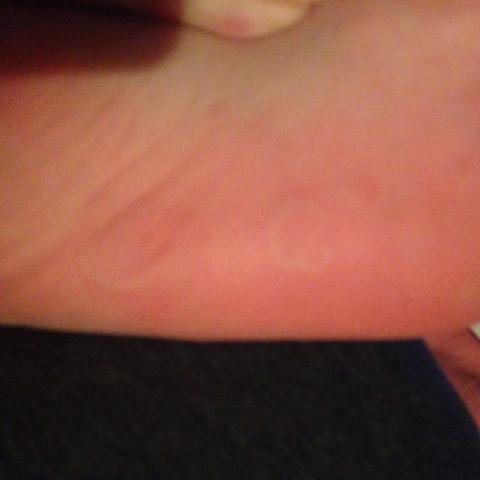 Juckreiz An Handflachen Und Fusssohlen Schmerzen Haut Schwellung Juckreiz An Handflachen Und Fusssohlen Schmerzen Haut Schwellung