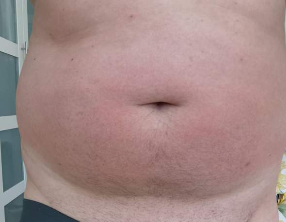 Juckreiz hilfe was könnte es sein? (Gesundheit und Medizin, Juckreiz am