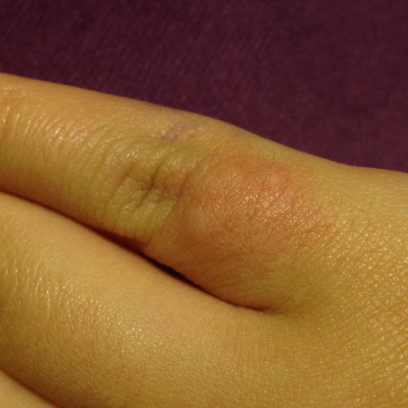 Kleine Bläschen Am Finger Ohne Juckreiz