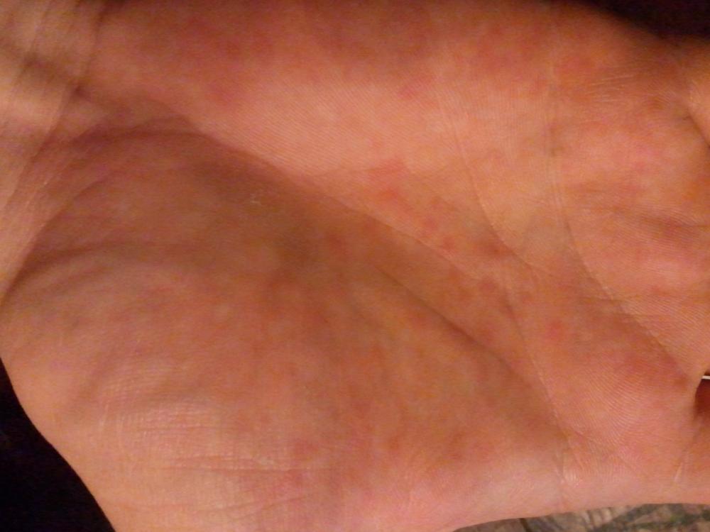 Jucken In Der Handfläche Jucken In Der Handfläche