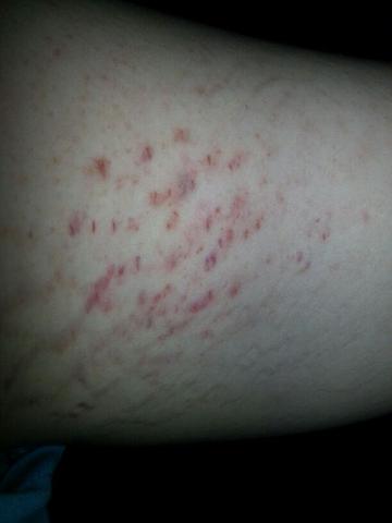 Juckreiz Mit Kleinen Roten Punkten Gesundheit Juckreiz Mit Kleinen Roten Punkten Gesundheit