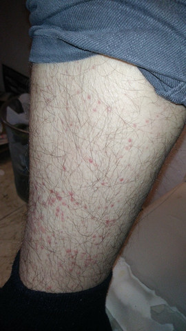 Juckreiz Und Rote Punkte Am Bein Jucken Bluterguss Rote Punkte Juckreiz Und Rote Punkte Am Bein Jucken Bluterguss Rote Punkte