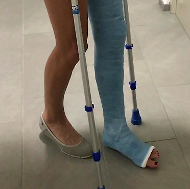 Bein gebrochen gips krücken