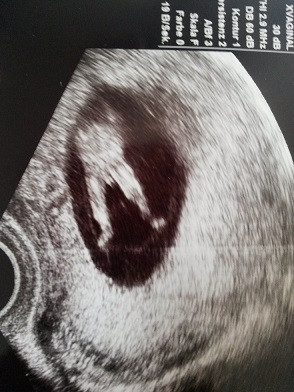 57 Best Pictures Herzschlag Ultraschall Ab Wann - Schwangerschaft ab wann mittels Ultraschall sichtbar ...