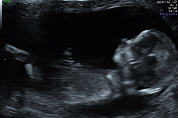 Junge Oder Madchen Was Sagt Ihr Schwangerschaft Junge Oder Madchen Was Sagt Ihr Schwangerschaft