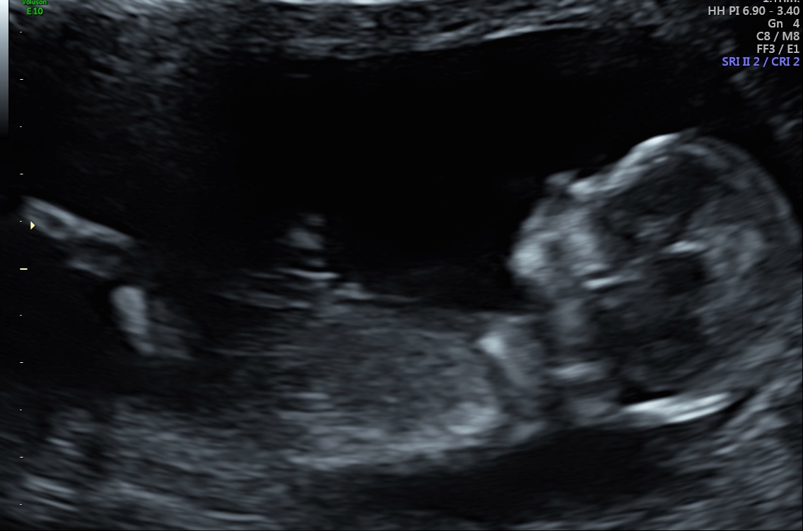 Junge oder Mädchen was sagt ihr? (Schwangerschaft)