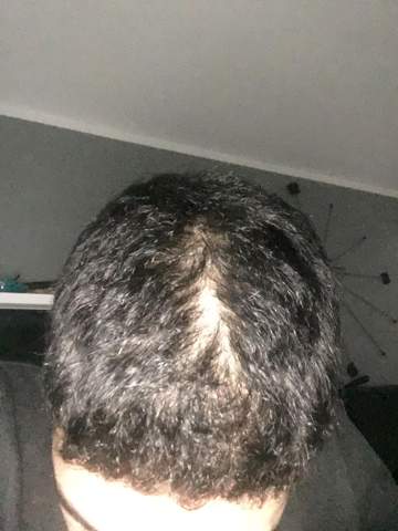 Kahle Stelle Am Kopf Mit 14 Haare Haarausfall 14 Jahre Alt Kahle Stelle Am Kopf Mit 14 Haare Haarausfall 14 Jahre Alt