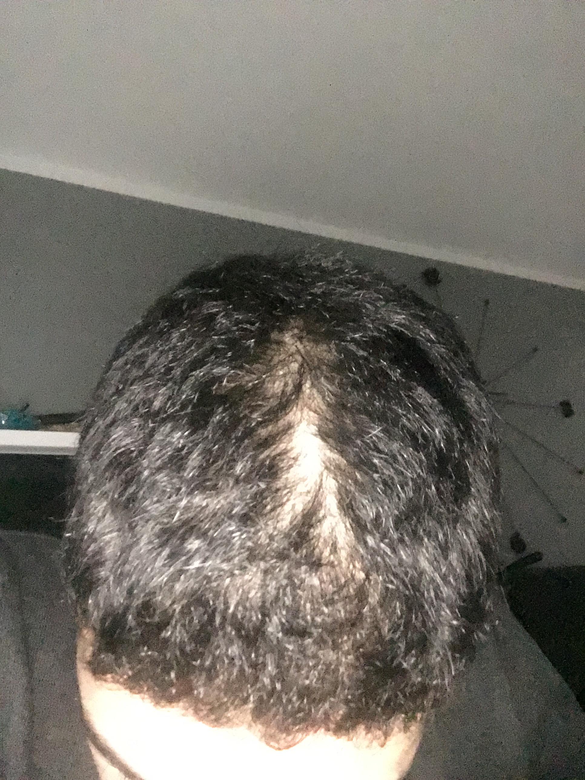 kahle stelle am kopf mit 14 haare