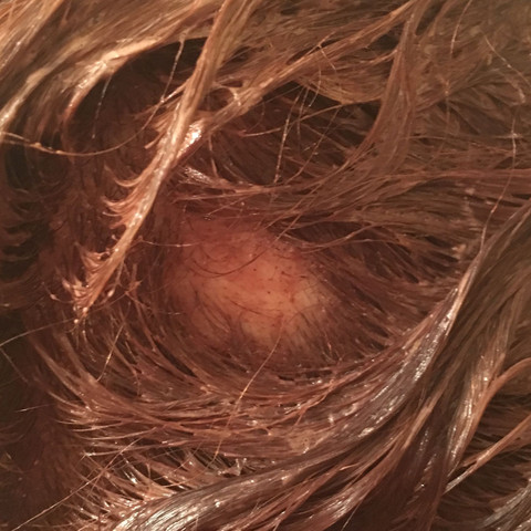 Kahle Stelle Am Kopf Woher Haare Korper Krankheit Kahle Stelle Am Kopf Woher Haare Korper Krankheit