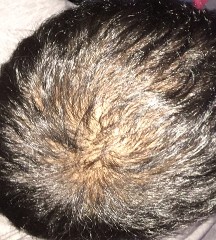 Was kann man gegen eine Kahle Stellen in den Haaren machen?