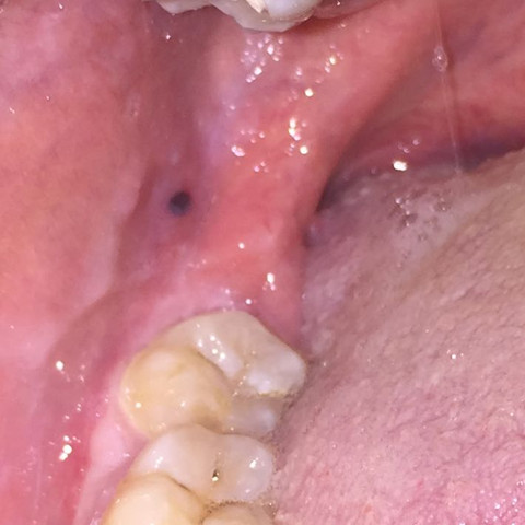 Kann Das Ein Bluterguss Sein Gesundheit Und Medizin Schwarzer Fleck Kann Das Ein Bluterguss Sein Gesundheit Und Medizin Schwarzer Fleck