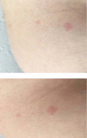 Kann Das Ein Hiv Ausschlag Sein Oder Was Ist Das Gesundheit Und Medizin Aids Dermatologie