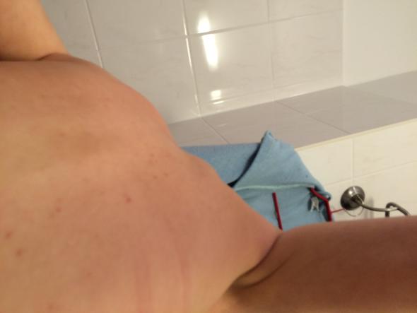 Kann Das Ein Hiv Ausschlag Sein Aids