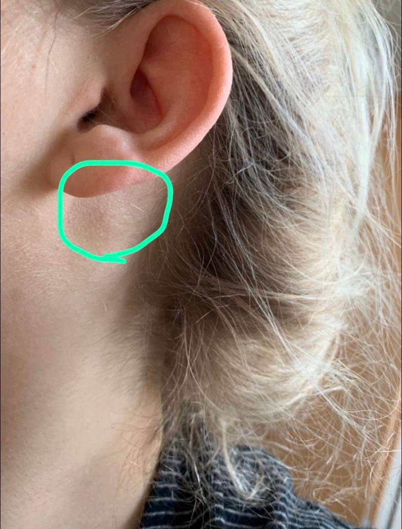 Kann das ein Lyphknoten sein? (Gesundheit und Medizin, Lymphknoten)