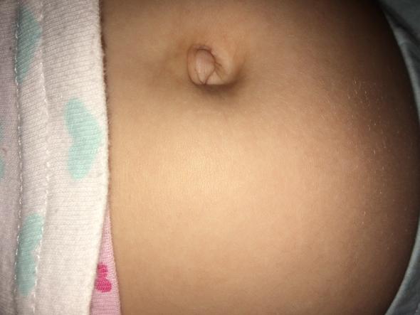 Kann das ein Nabelbruch sein? Kann das ein Nabelbruch sein?