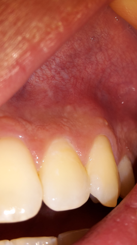 Zahnfleischentzündung - (Zähne, Entzündung)