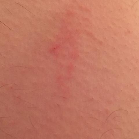 Kann Das Gurtelrose Sein Haut Herpes Hautausschlag Kann Das Gurtelrose Sein Haut Herpes Hautausschlag